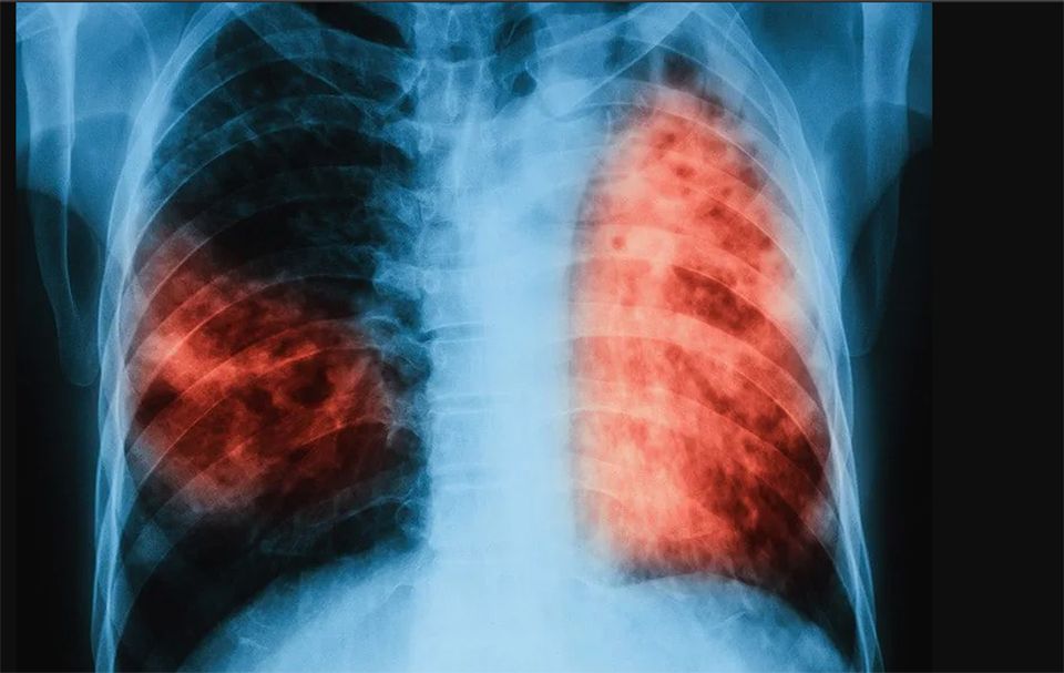 World TB Day,  Tetap Waspadai Risiko Infeksi Tuberkulosis